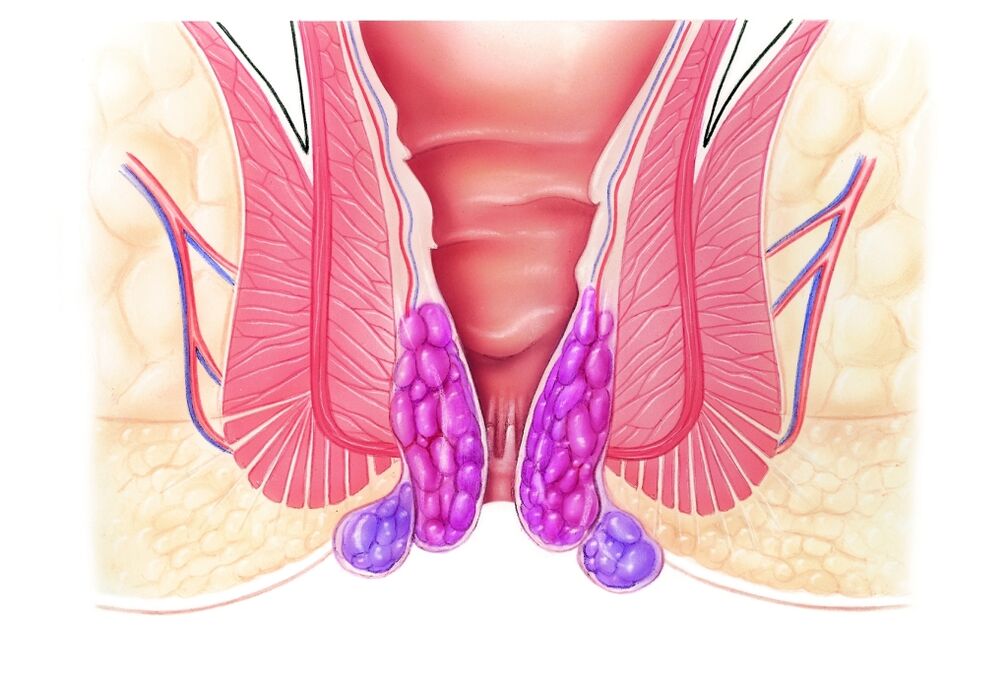 Wat ass hemorrhoiden